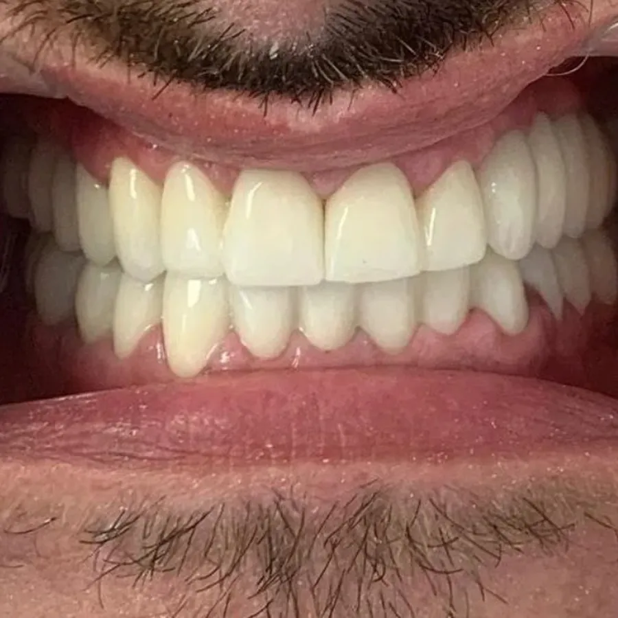 Dopo - Corone complete in zirconia