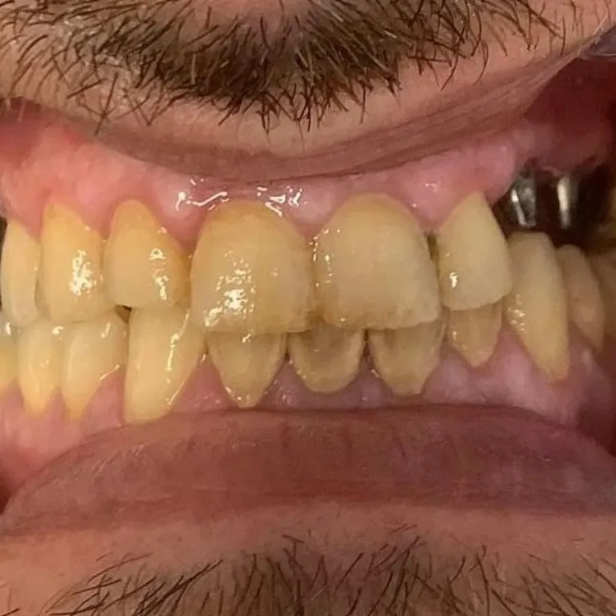 Prima - Corone complete in zirconia