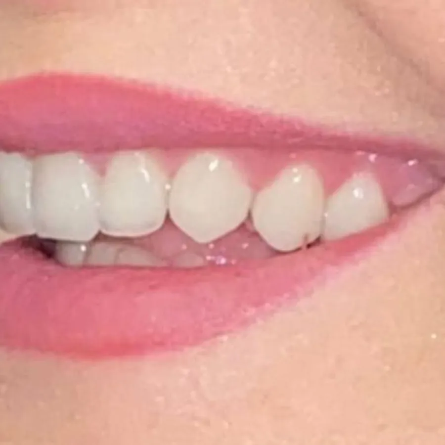 Dopo - Corone estetiche